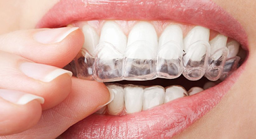 Unsichtbare Zahnspange - Dr. med. dent. Daniela Skiba, MSc - Zahnärztin Wien 1010