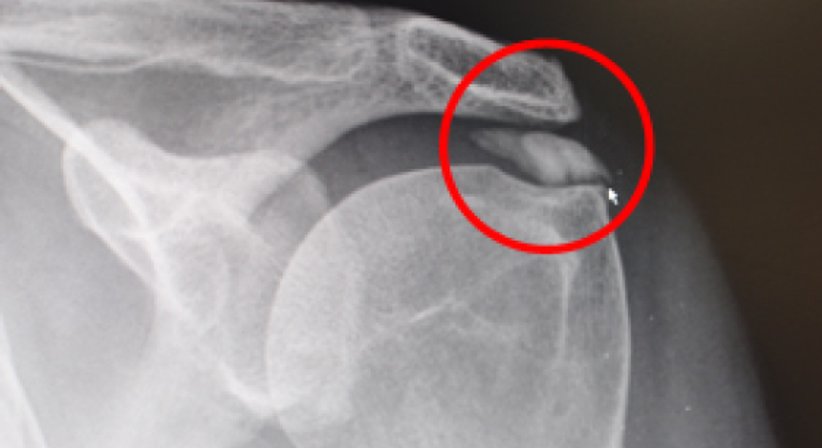 Kalkschulter - OA Dr.med.univ. Roman Christian Ostermann - Orthopäde Wien 1170