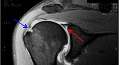 Rotatorenmanschettenruptur