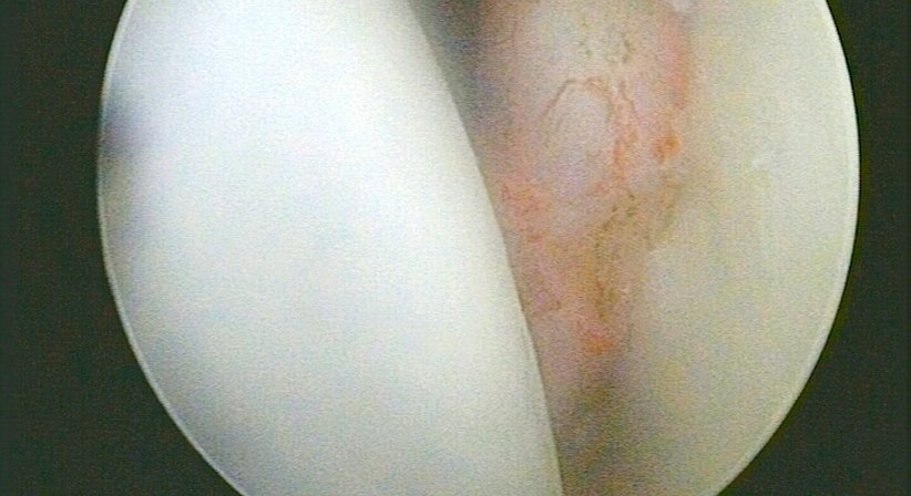 Schulterluxation - OA Dr.med.univ. Roman Christian Ostermann - Orthopäde Wien 1170