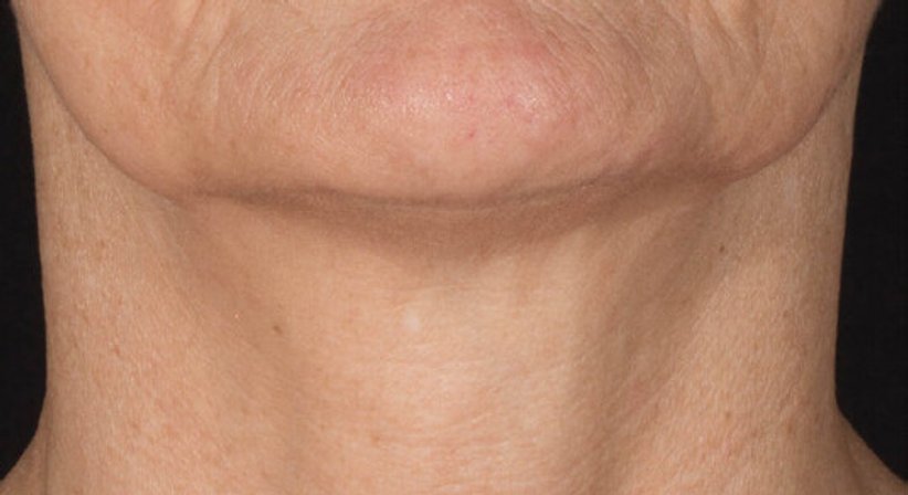 Radiofrequenz (RF) Microneedling - Ao. Univ.Prof. Dr. Tamara Kopp - Hautärztin Wien 1010