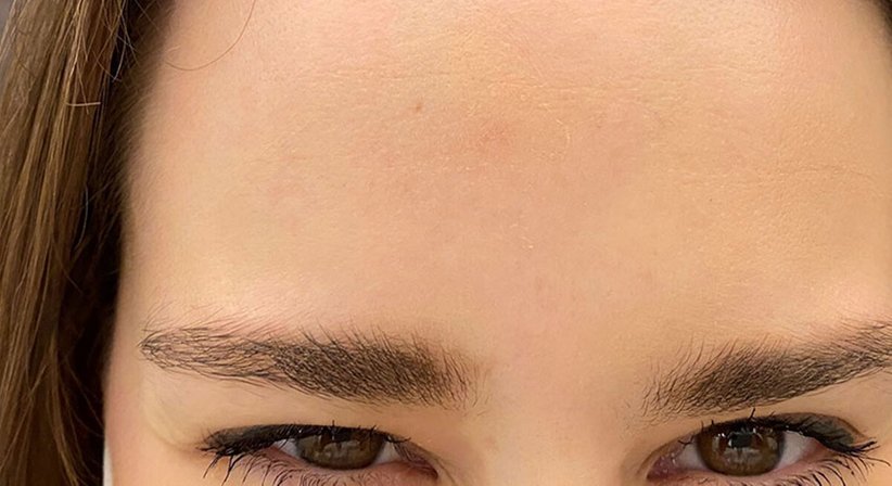 Botox®-Behandlung bei JUVENIS - Ao. Univ.Prof. Dr. Tamara Kopp - Hautärztin Wien 1010