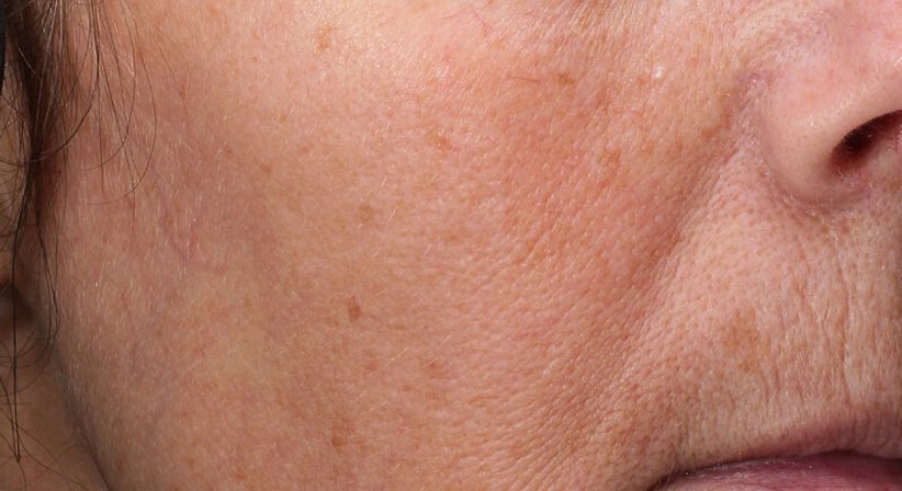 Radiofrequenz (RF) Microneedling - Ao. Univ.Prof. Dr. Tamara Kopp - Hautärztin Wien 1010