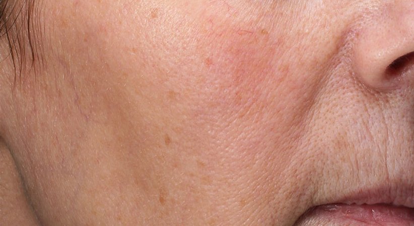 Radiofrequenz (RF) Microneedling - Ao. Univ.Prof. Dr. Tamara Kopp - Hautärztin Wien 1010