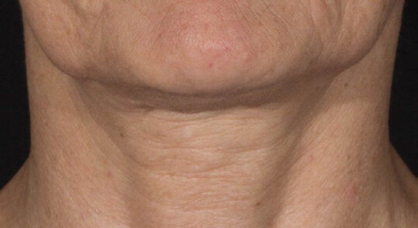 Radiofrequenz (RF) Microneedling - Ao. Univ.Prof. Dr. Tamara Kopp - Hautärztin Wien 1010