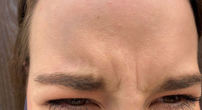 Botox®-Behandlung bei JUVENIS - Ao. Univ.Prof. Dr. Tamara Kopp - Hautärztin Wien 1010