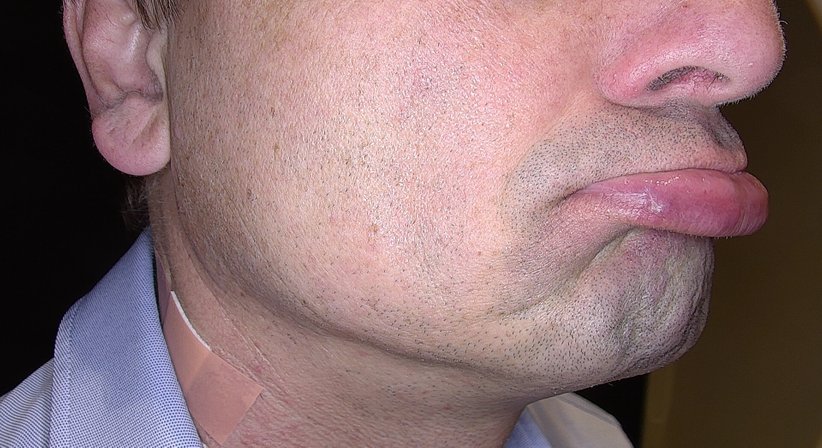 Blutschwämmchen (Hämangiome) und erweiterte Äderchen (Teleangiektasien) behandeln - Ao. Univ.Prof. Dr. Tamara Kopp - Hautärztin Wien 1010