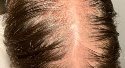 Plasmabehandlung gegen Haarausfall (Alopezie)