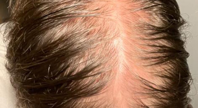 Plasmabehandlung gegen Haarausfall (Alopezie) - Ao. Univ.Prof. Dr. Tamara Kopp - Hautärztin Wien 1010