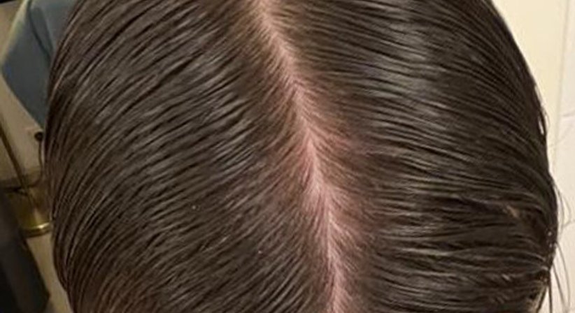 Plasmabehandlung gegen Haarausfall (Alopezie) - Ao. Univ.Prof. Dr. Tamara Kopp - Hautärztin Wien 1010