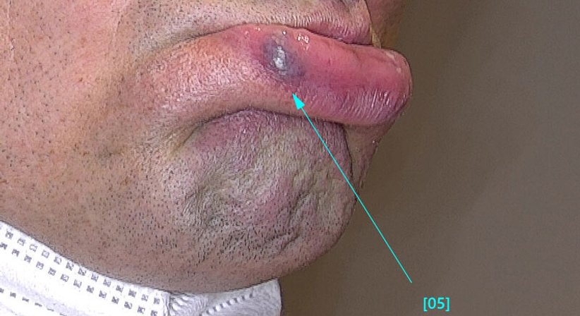 Blutschwämmchen (Hämangiome) und erweiterte Äderchen (Teleangiektasien) behandeln - Ao. Univ.Prof. Dr. Tamara Kopp - Hautärztin Wien 1010