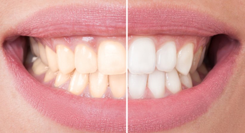 Bleaching - Dr. Evelyn Raab-Kronister - Zahnärztin Deutsch-Wagram 2232