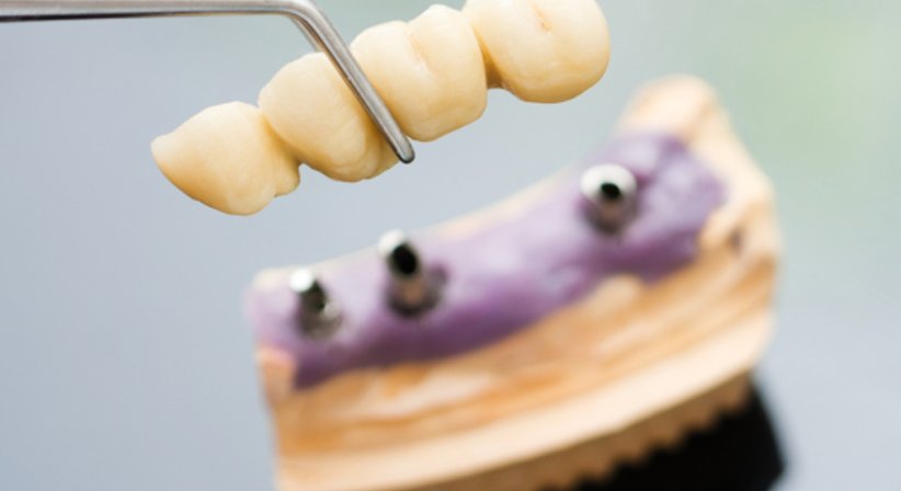 Zahnimplantate - Dr. Evelyn Raab-Kronister - Zahnärztin Deutsch-Wagram 2232