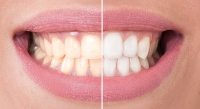 Bleaching - Zahnaufhellung 