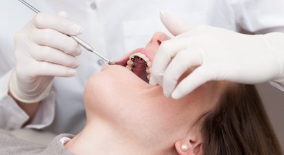 Unsichtbare Zahnspangen für Erwachsene (Lingualzahnspangen)