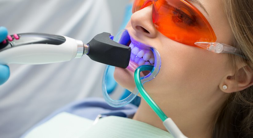 Bleaching (Zahnaufhellung) - Dr. Daniel Bank - Zahnarzt Wien 1040