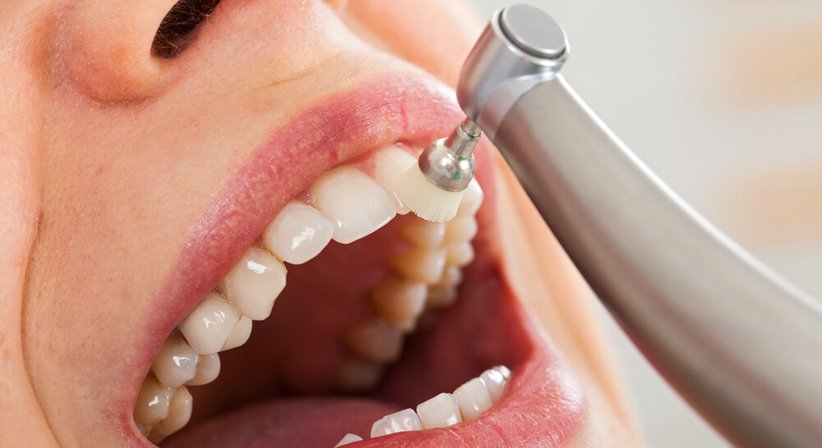 Professionelle Mundhygiene / Zahnprophylaxe - Dr. Daniel Bank - Zahnarzt Wien 1040