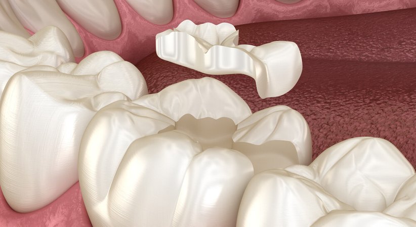 Inlays / Veneers - Dr. Daniel Bank - Zahnarzt Wien 1040