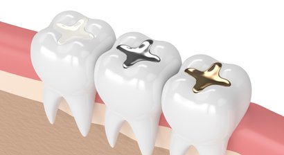 Ästhetische Kunststofffüllungen (Komposit)