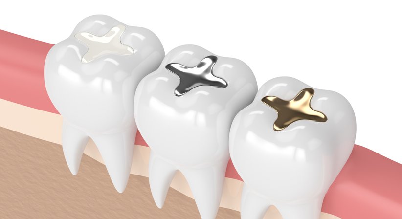 Ästhetische Kunststofffüllungen (Komposit) - Dr. Daniel Bank - Zahnarzt Wien 1040