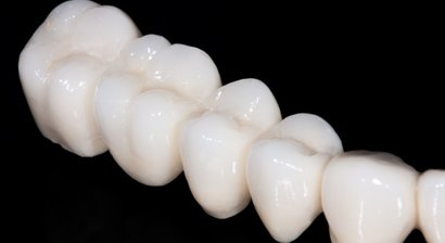 Digitale Abformung und Planung von Zahnkronen