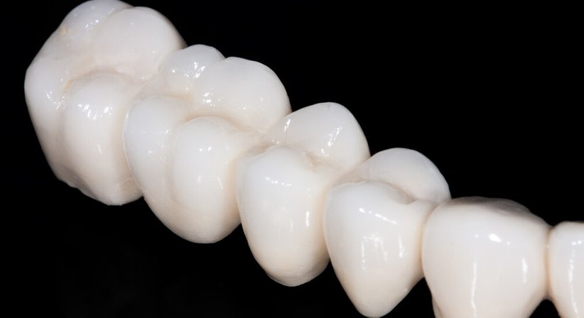 Digitale Abformung und Planung von Zahnkronen - Dr. Daniel Bank - Zahnarzt Wien 1040