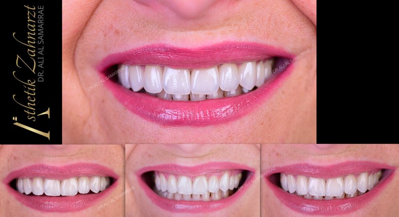 Veneers und Lumineers - Dr. med. dent. Ali Al-Samarrae - Zahnarzt Wien 1040