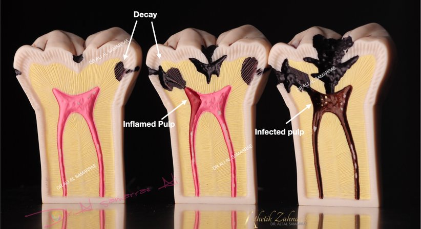 Zahnwurzelbehandlung - Endodontie - Dr. med. dent. Ali Al-Samarrae - Zahnarzt Wien 1040