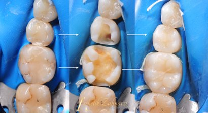Zahnfüllungen und Inlays