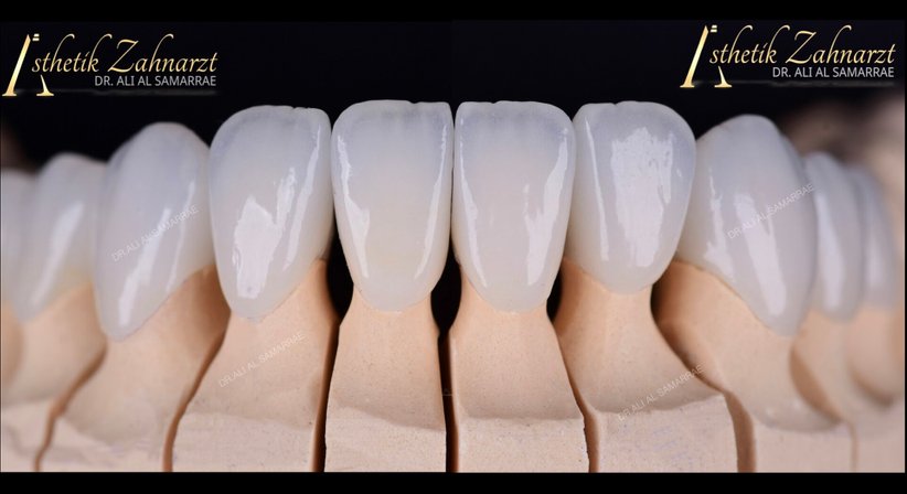 Veneers und Lumineers - Dr. med. dent. Ali Al-Samarrae - Zahnarzt Wien 1040