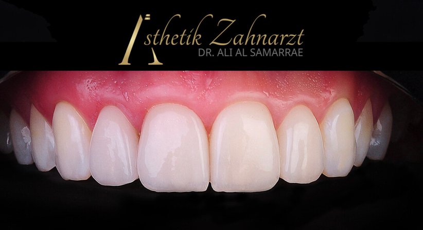 Kunststofffüllung-Frontzähne - Dr. med. dent. Ali Al-Samarrae - Zahnarzt Wien 1040