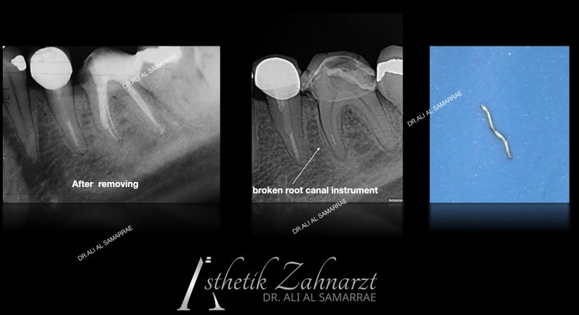 Zahnwurzelbehandlung - Endodontie - Dr. med. dent. Ali Al-Samarrae - Zahnarzt Wien 1040