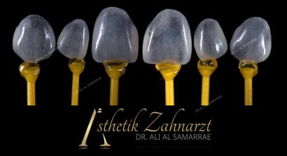 Veneers und Lumineers