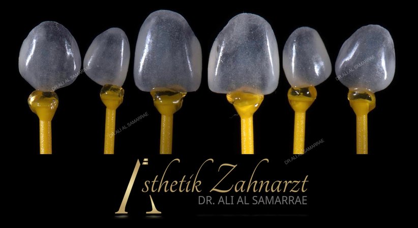 Veneers und Lumineers - Dr. med. dent. Ali Al-Samarrae - Zahnarzt Wien 1040