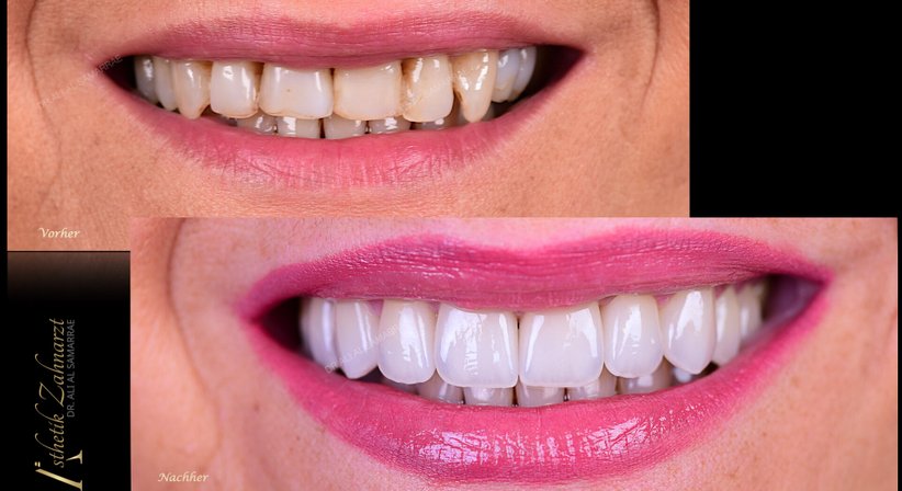 Veneers und Lumineers - Dr. med. dent. Ali Al-Samarrae - Zahnarzt Wien 1040