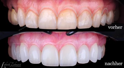 Zahnkrone - Zahnbrücke