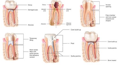 Zahnwurzelbehandlung - Endodontie