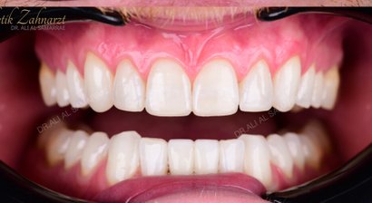 Kunststofffüllung-Frontzähne