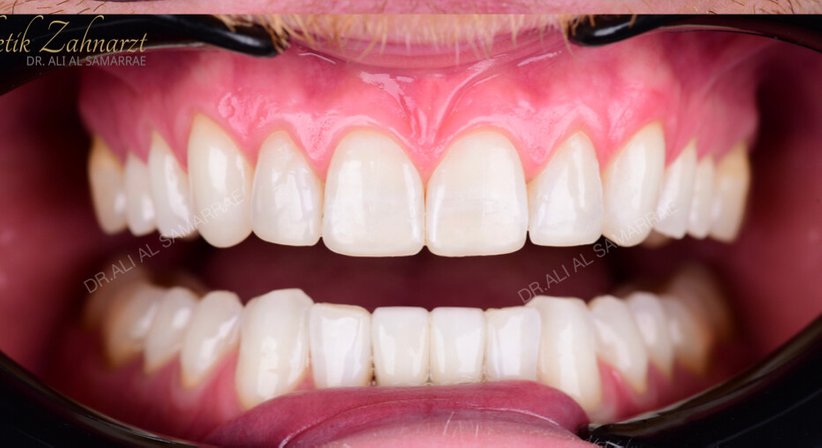 Kunststofffüllung-Frontzähne - Dr. med. dent. Ali Al-Samarrae - Zahnarzt Wien 1040