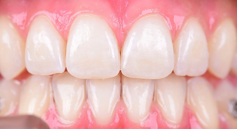 Kunststofffüllung-Frontzähne - Dr. med. dent. Ali Al-Samarrae - Zahnarzt Wien 1040