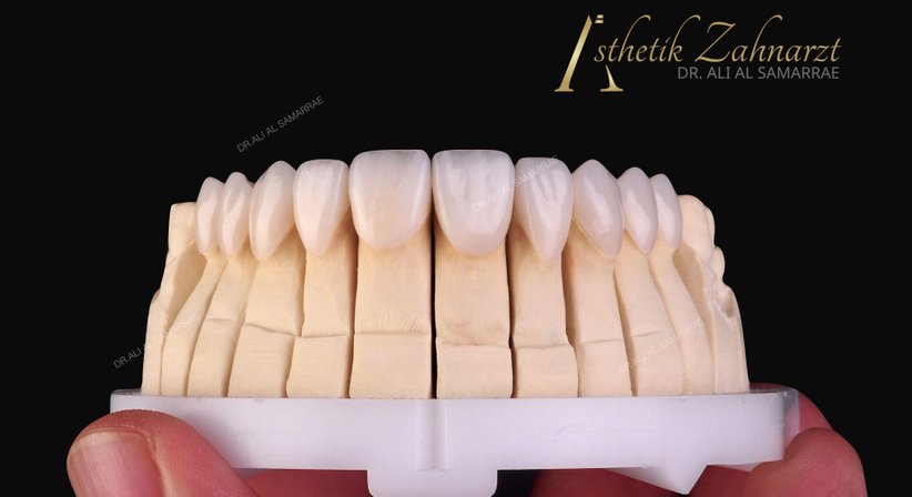 Zahnkrone - Zahnbrücke - Dr. med. dent. Ali Al-Samarrae - Zahnarzt Wien 1040