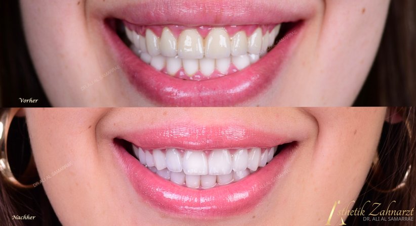 Veneers und Lumineers - Dr. med. dent. Ali Al-Samarrae - Zahnarzt Wien 1040