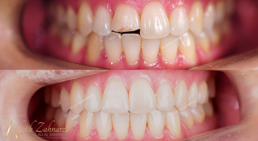 Kunststofffüllung-Frontzähne - Dr. med. dent. Ali Al-Samarrae - Zahnarzt Wien 1040