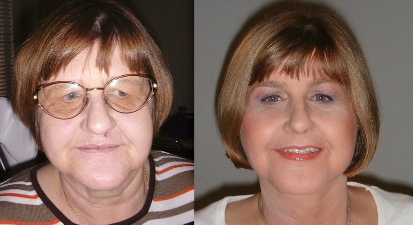 Ästhetische Gesichtschirurgie zur Gesichtsverjüngung im Gesamtspektrum der Gesichtsalterung - Univ.-Prof. DDr. Kurt Vinzenz - Kieferchirurg Wien 1010