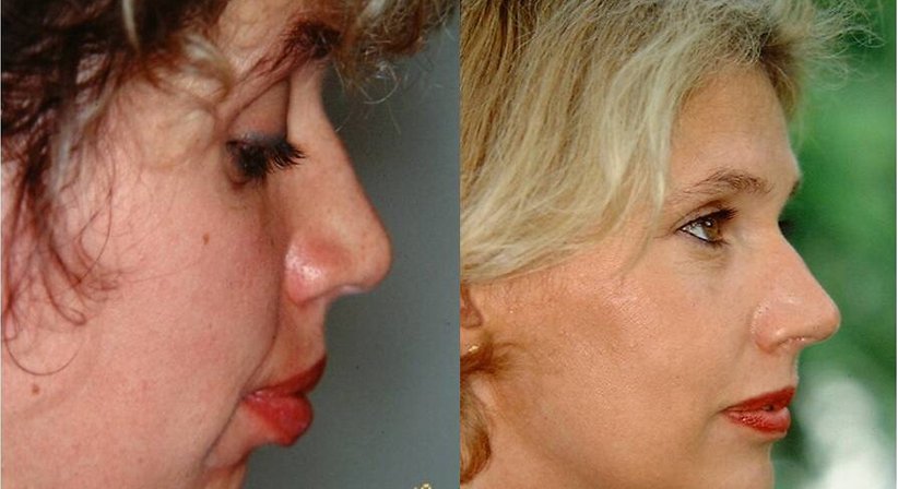 Ästhetische Gesichtschirurgie zur Gesichtsverjüngung im Gesamtspektrum der Gesichtsalterung - Univ.-Prof. DDr. Kurt Vinzenz - Kieferchirurg Wien 1010