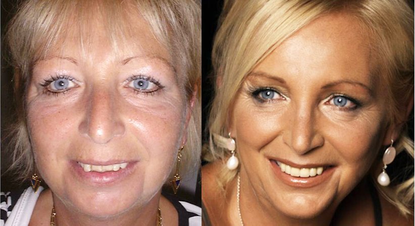 Ästhetische Gesichtschirurgie zur Gesichtsverjüngung im Gesamtspektrum der Gesichtsalterung - Univ.-Prof. DDr. Kurt Vinzenz - Kieferchirurg Wien 1010