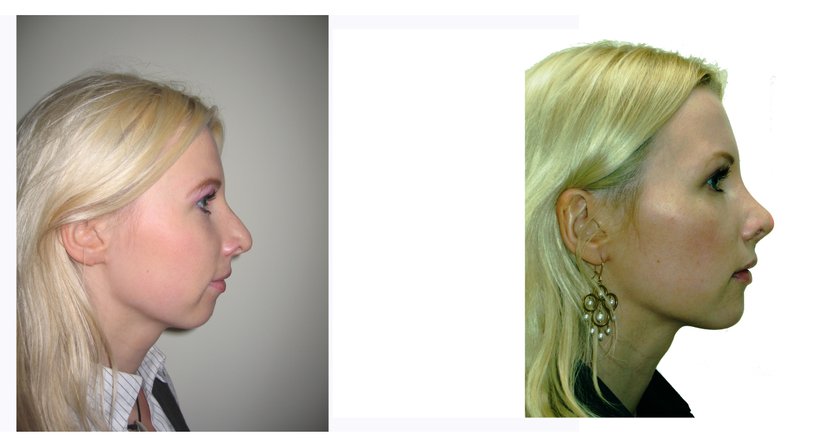 Ästhetische Gesichtschirurgie zur Gesichtsverjüngung im Gesamtspektrum der Gesichtsalterung - Univ.-Prof. DDr. Kurt Vinzenz - Kieferchirurg Wien 1010