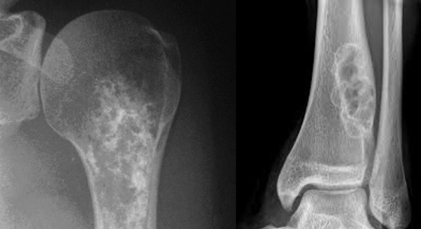 Knochen- und Weichteiltumore - Priv.-Doz. DDr. Jörg Friesenbichler - Orthopäde Rosental an der Kainach 8582