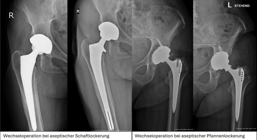 Revisionsoperationen Hüfte - Priv.-Doz. DDr. Jörg Friesenbichler - Orthopäde Rosental an der Kainach 8582
