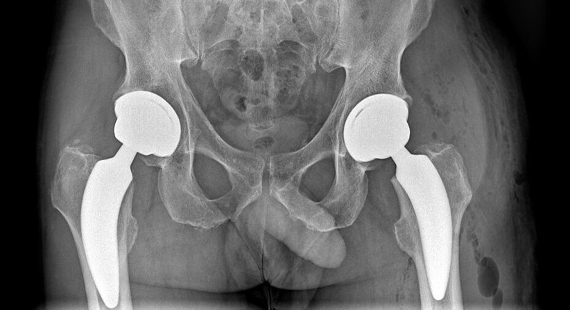 Endoprothetik Hüfte - Priv.-Doz. DDr. Jörg Friesenbichler - Orthopäde Rosental an der Kainach 8582